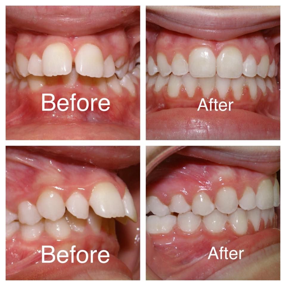 Orthodontic Treatment (Braces)